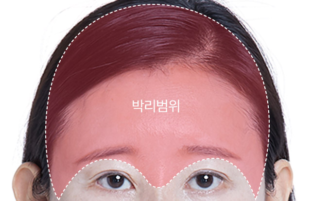 STEP 01 디자인 개개인의 노화상태, 피부조직 주름방향, 처짐 상태에 따라 성형플랜을 세우고 디자인을 진행합니다.