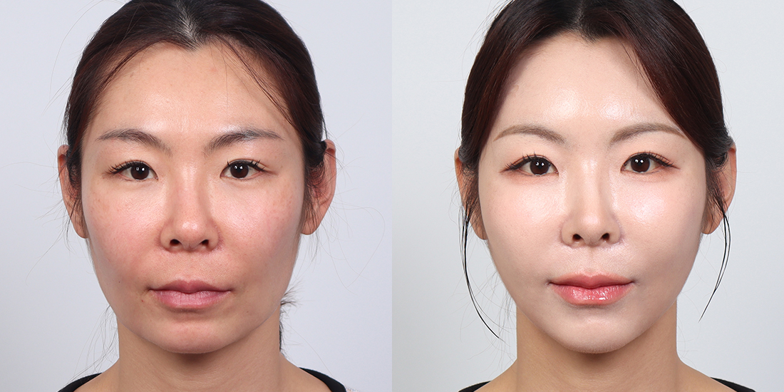 얼굴 지방 이식 전후 사진