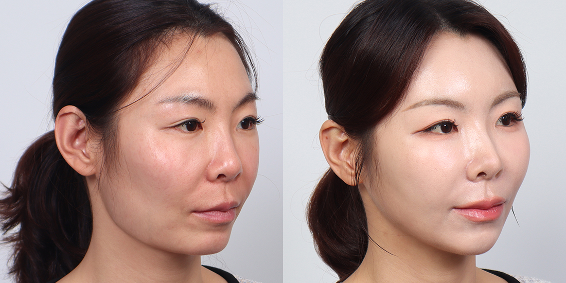 얼굴 지방 이식 전후 사진