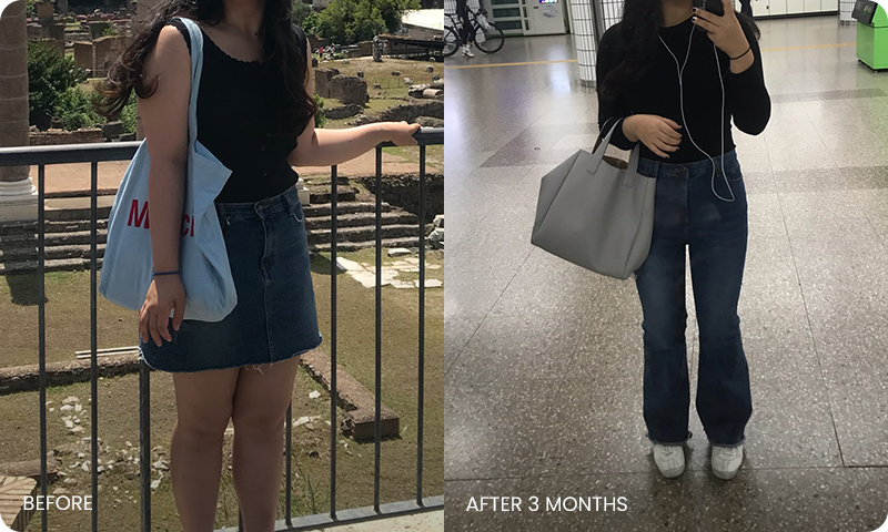 팔-복부 동시 지방흡입 전후사진