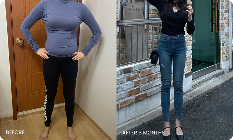 팔-복부 동시 지방흡입 전후사진