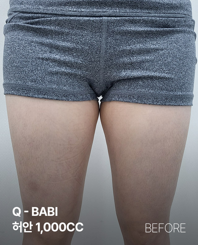 전후사진