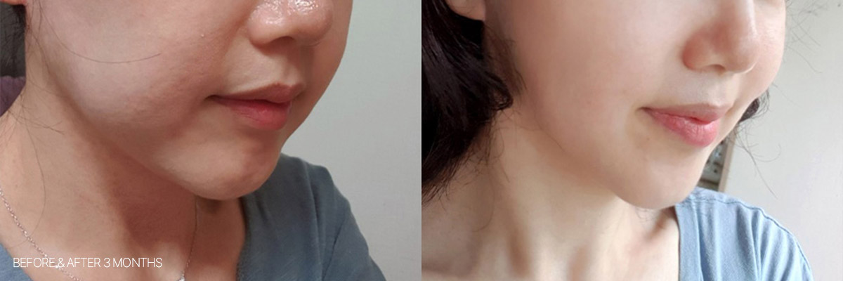 레이저리프팅 전후사진