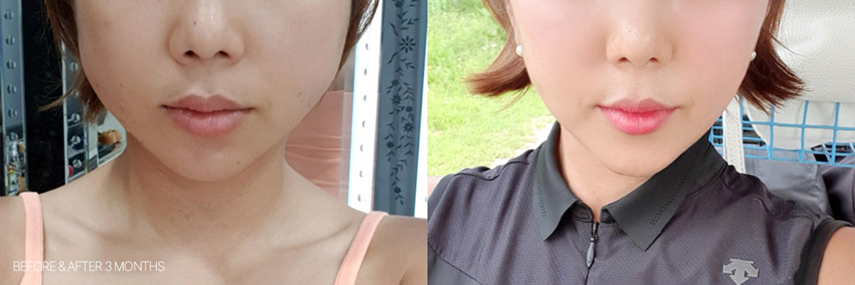 레이저리프팅 전후사진