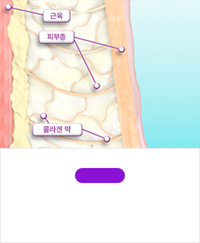 STEP 01노화로 인해 늘어지고 오래된 콜라겐