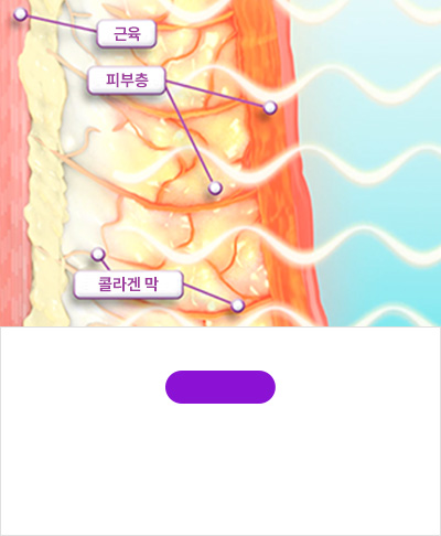 STEP 02써마지FLX로 고주파 에너지를 진피에 전달