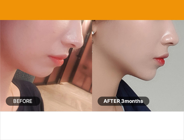 샷 수 : 300샷 / 연령 대 : 20~30 초반 지방이 많은 처진 턱 선, 이중 턱 3.0mm 100샷 + 4.5mm 200샷