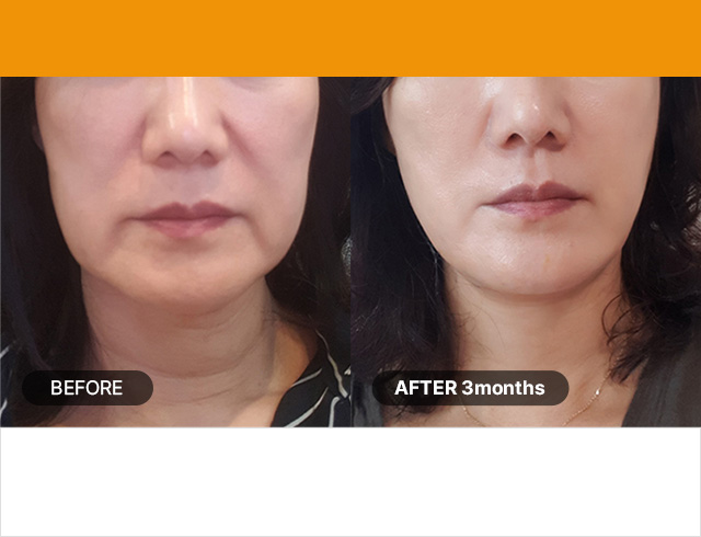 샷 수 : 200샷 / 연령 대 : 40대 ~ 눈 주변 집중 아이울쎄라 1.5mm 내로우150샷 + 3.0mm 50샷