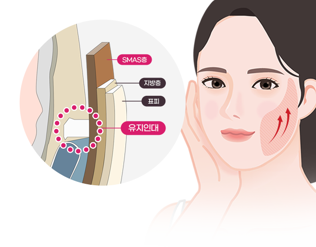 유지인대를 끊어야 진짜! 고정된 유지인대를 끊고 스마스층을 최대한 당겨주어 강력한 리프팅효과를 기대할 수 있습니다.