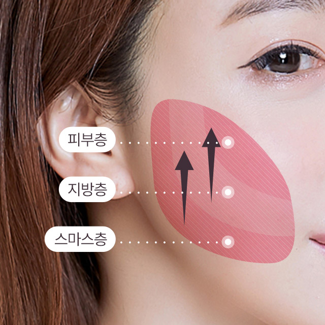 늘어진 피부제거와 스마스층까지 당겨 고정