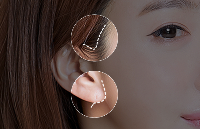POINT 01 풀거상보다 작은 절개 흉터