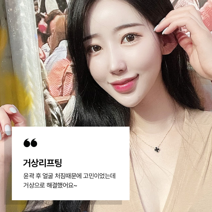 거상리프팅 시술후기