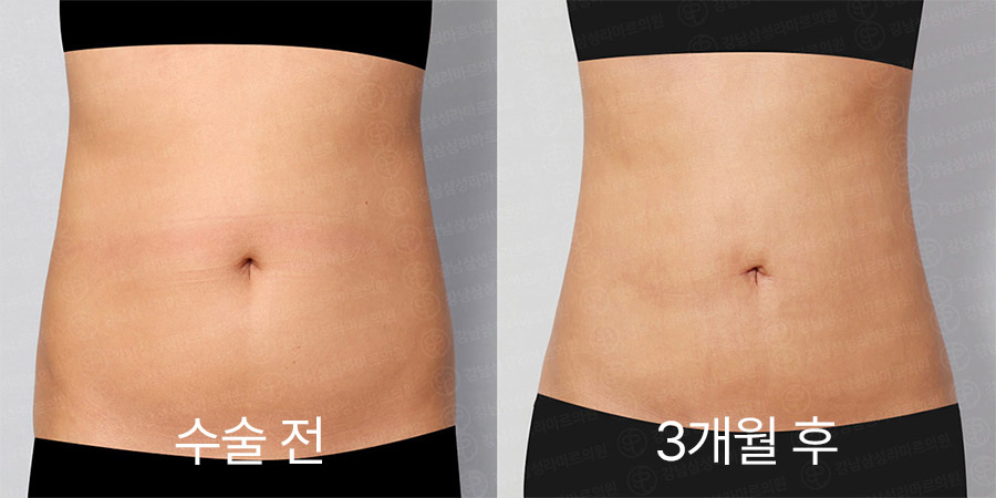 전후사진