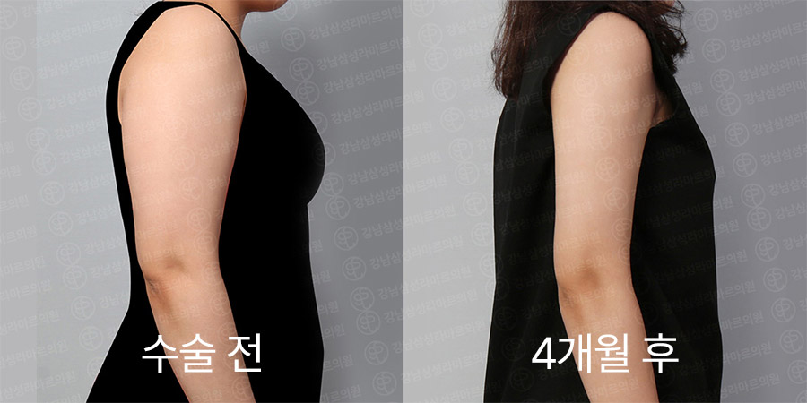 룩팻 전후사진