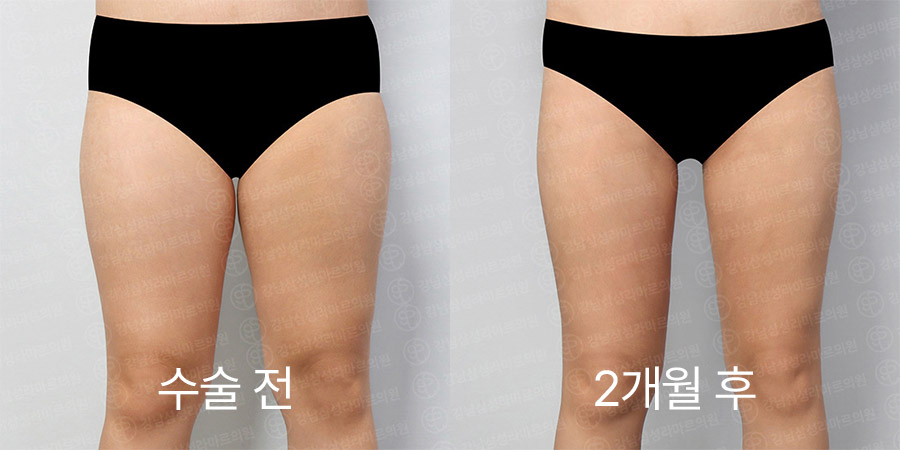 룩팻 전후사진