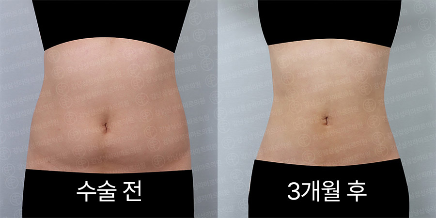 복부360 전후사진