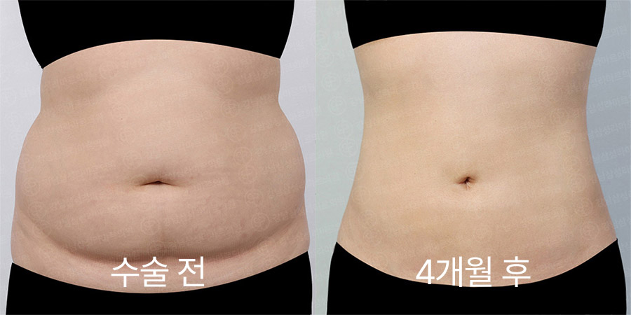 복부360 전후사진