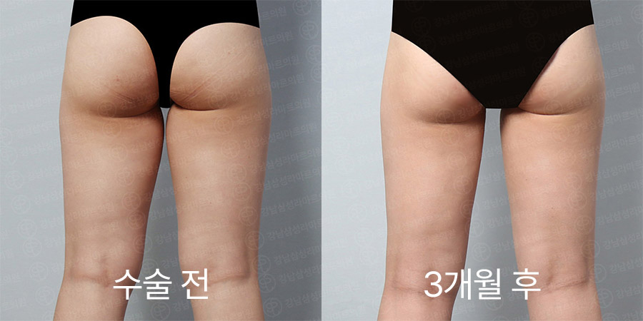 허벅지360 전후사진