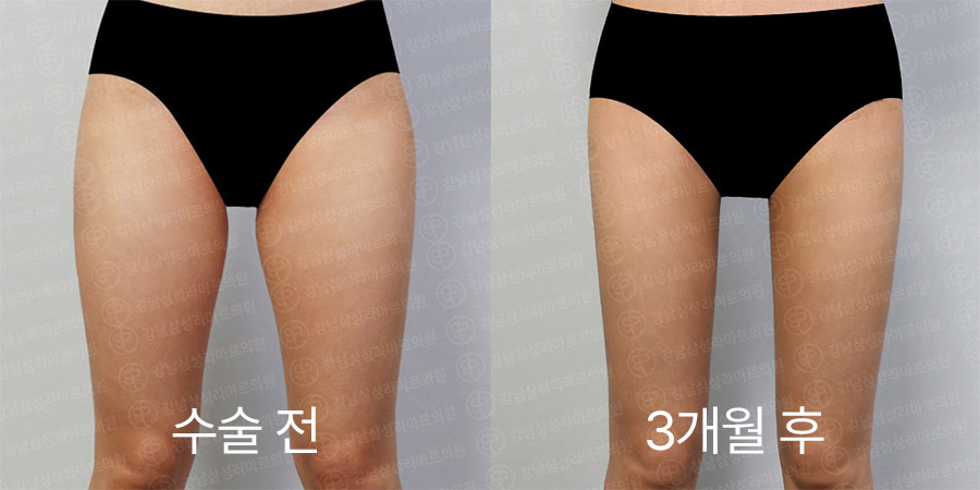 허벅지360 전후사진