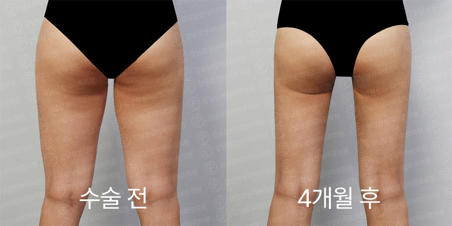 허벅지360 전후사진