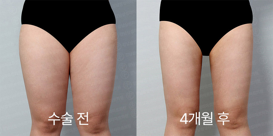 허벅지360 전후사진