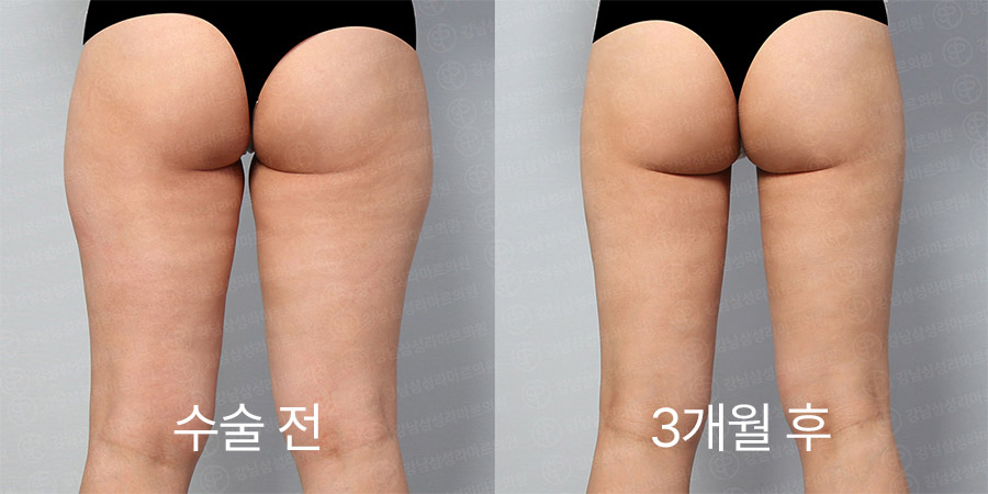 허벅지360 전후사진