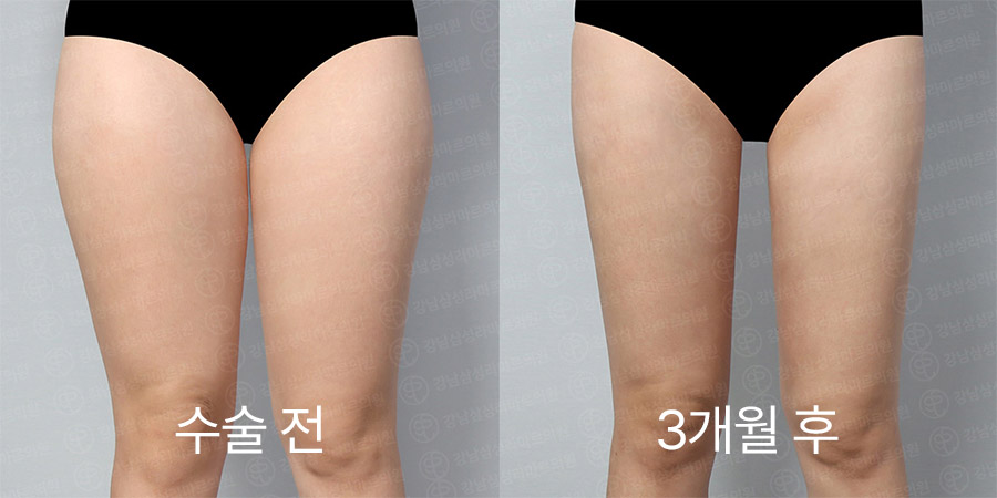 허벅지360 전후사진