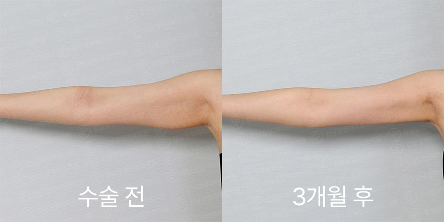 팔360 전후사진