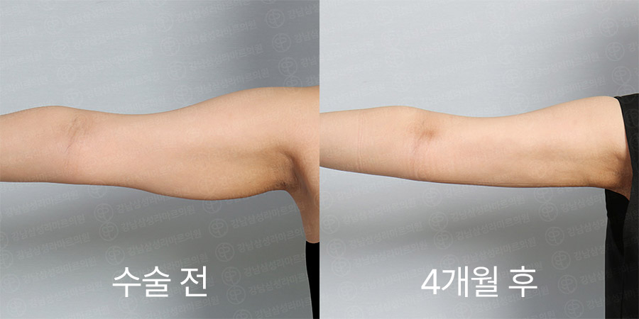 팔360 전후사진
