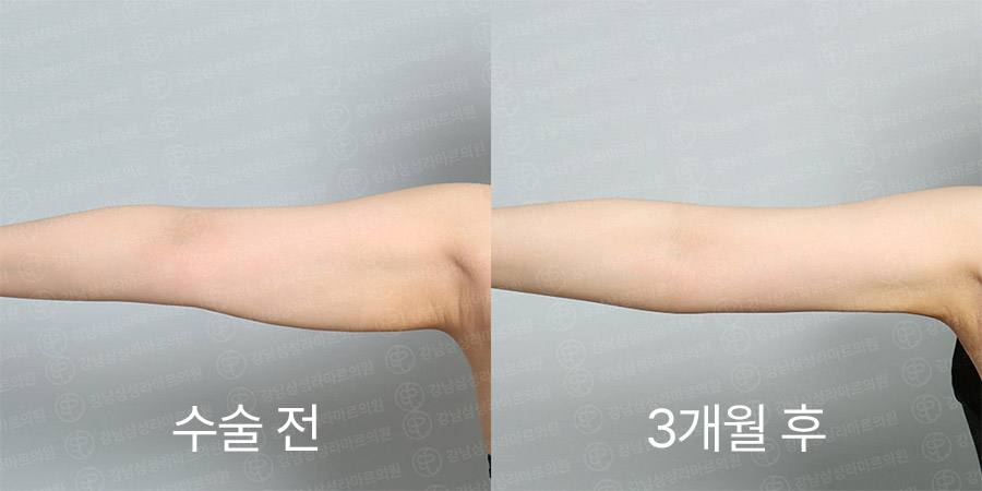 팔360 전후사진