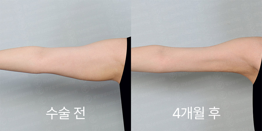 팔360 전후사진