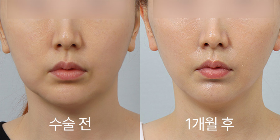 얼굴리프팅 전후사진