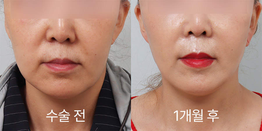 얼굴리프팅 전후사진