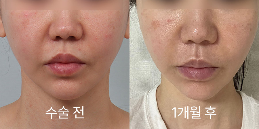 얼굴리프팅 전후사진