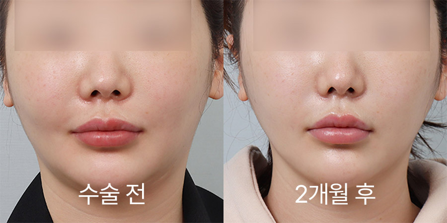 얼굴리프팅 전후사진