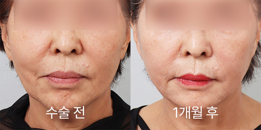 얼굴리프팅 전후사진