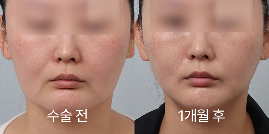 얼굴리프팅 전후사진