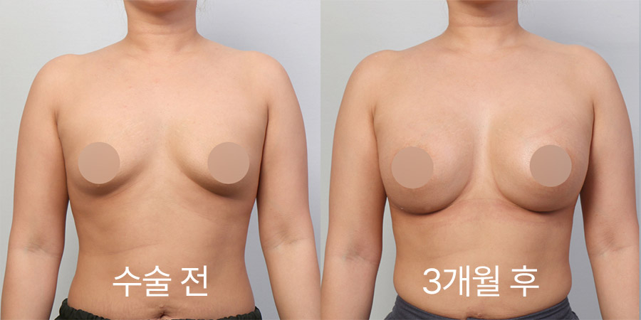 가슴성형 전후사진