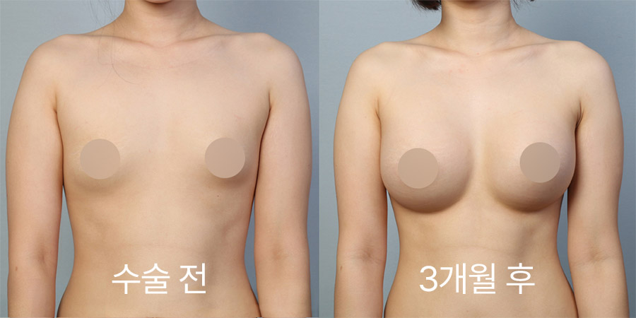 가슴성형 전후사진