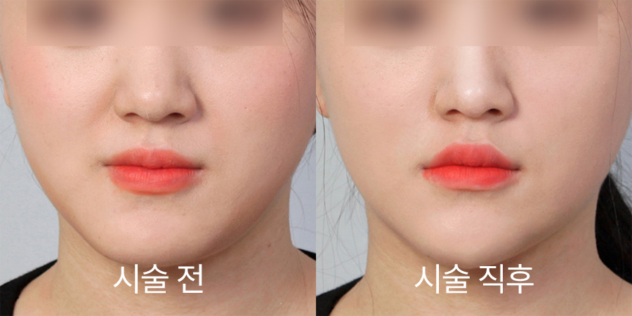 쁘띠성형 전후사진