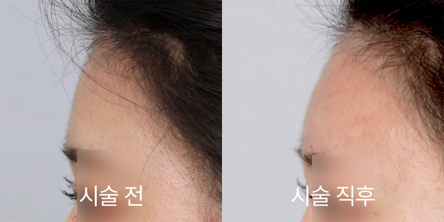 쁘띠성형 전후사진