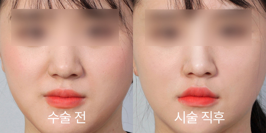 쁘띠성형 전후사진