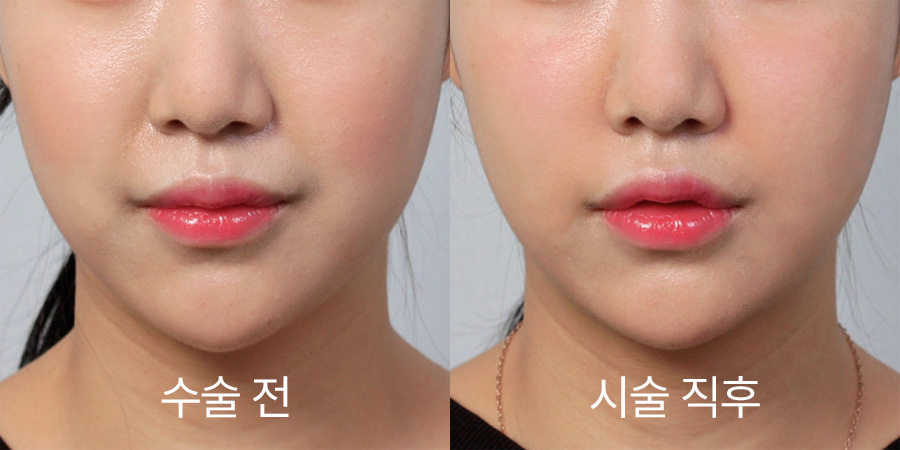 쁘띠성형 전후사진