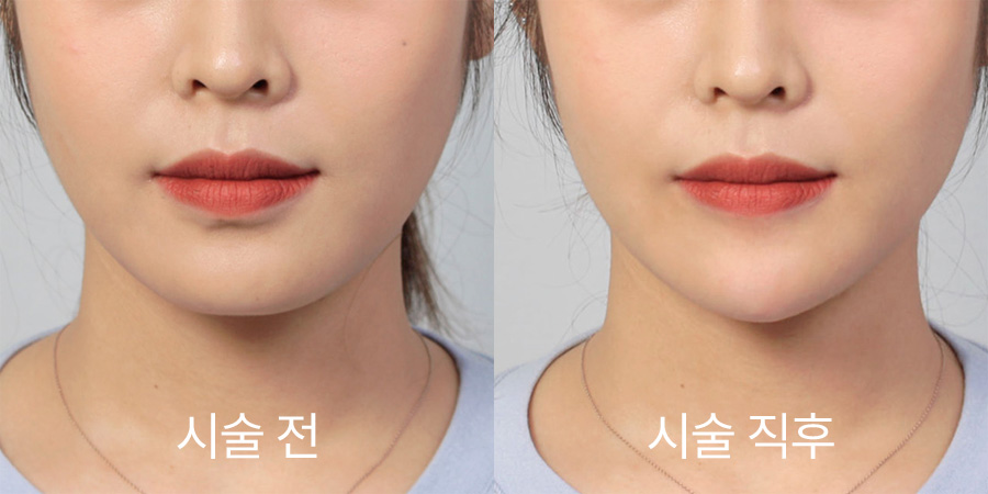 쁘띠성형 전후사진