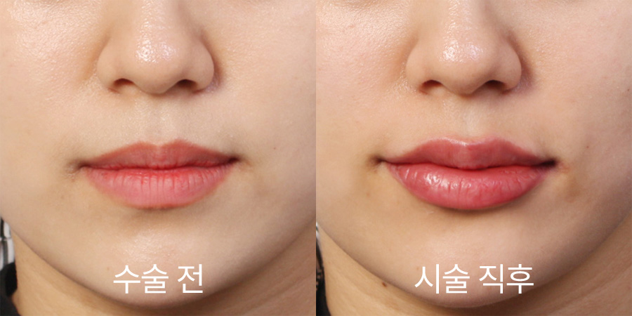 쁘띠성형 전후사진