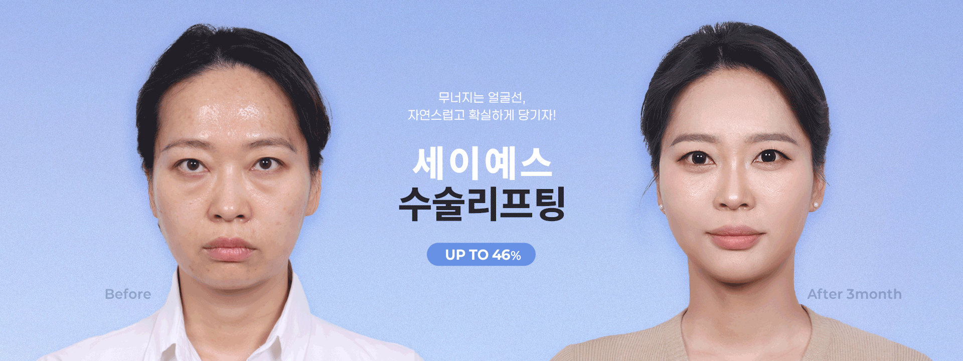 수술 리프팅 최대 46% 노화로 인한 처짐 정도와 주름 깊이에 따라 가장 적합한 수술플랜을 찾아드립니다.
