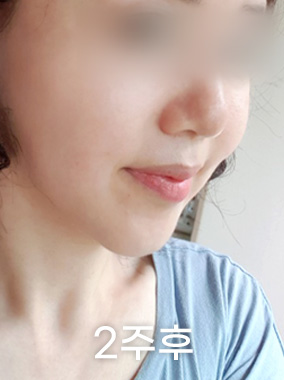 울쎄라 리프팅 전후사진