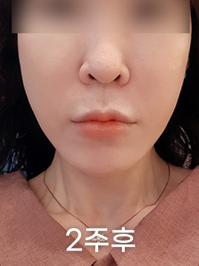 울쎄라 리프팅 전후사진