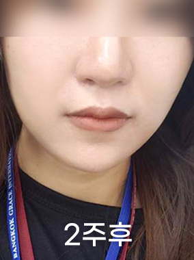 울쎄라 리프팅 전후사진