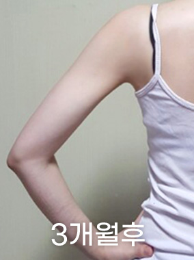 순수지방추출 룩팻 전후사진